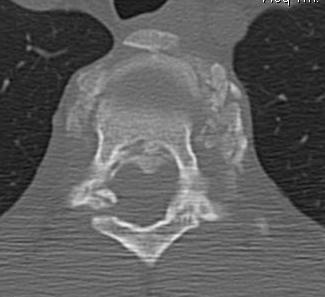 Thoracic Burst CT Canal Fragment Axial
